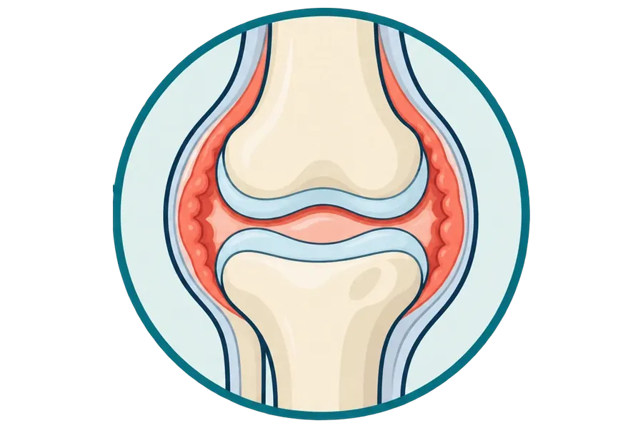 Knee osteoarthritis: worn cartilage and bone changes