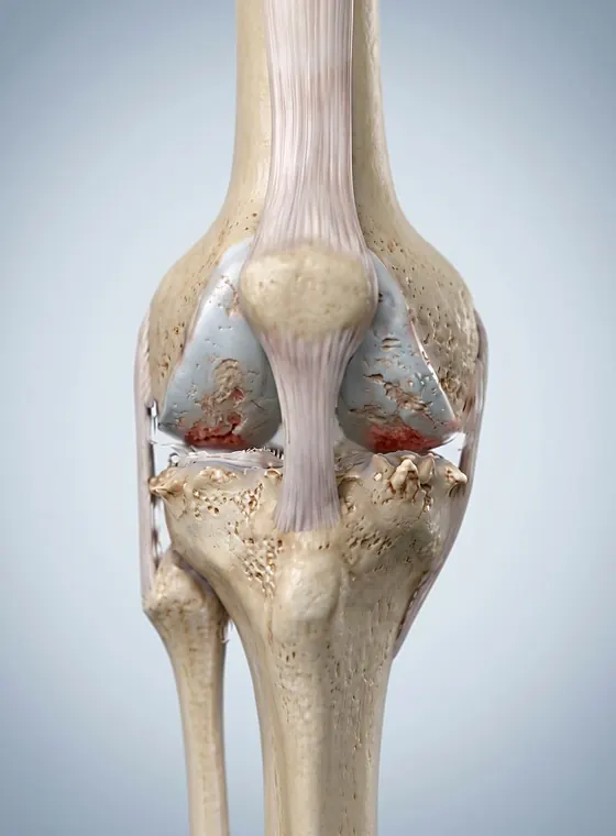 Gout: knee joint with crystal deposits and bony changes