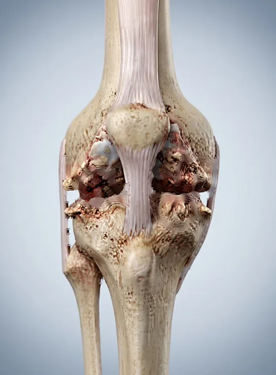 Post-injury arthritis: severely worn knee joint